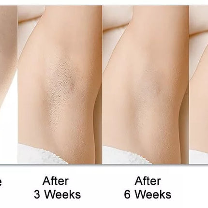 BDI Permanent IPL Hair Removal Device 400K Pulses Intense Pulsed Light Epilator